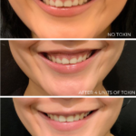 gummy smile toxin treatment(1)